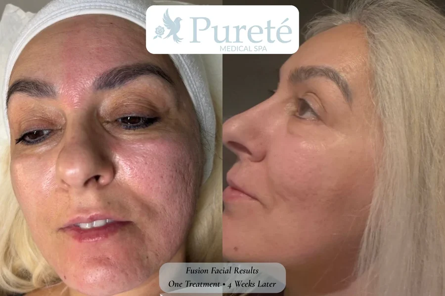 Skin rejuvenation results at Pureté Medical Spa in Toronto — smoother texture, brighter tone and a natural glow