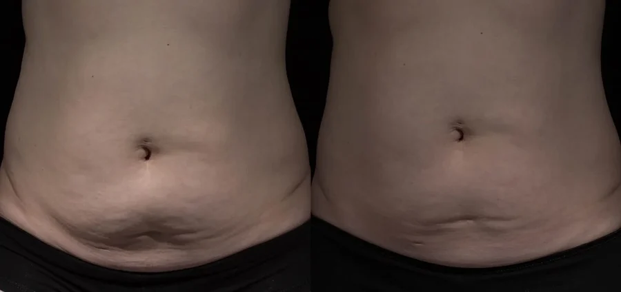 Body skin tightening — manufacturer clinical results, shown unretouched