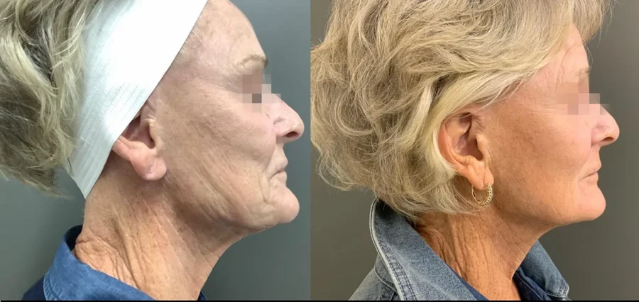 Firmer, lifted skin — RF microneedling results