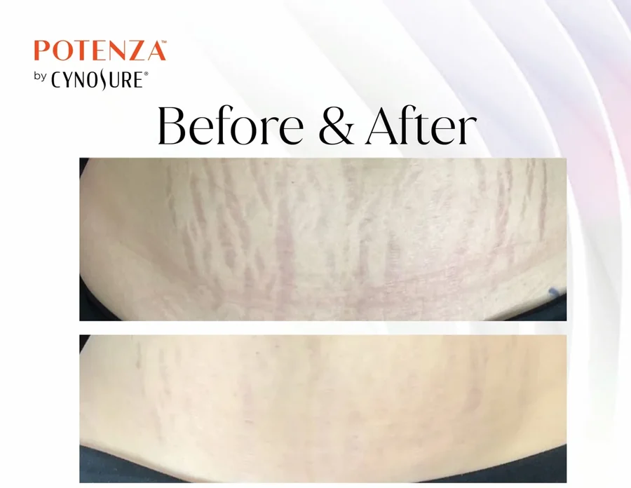 Stretch mark improvement before and after Potenza RF microneedling