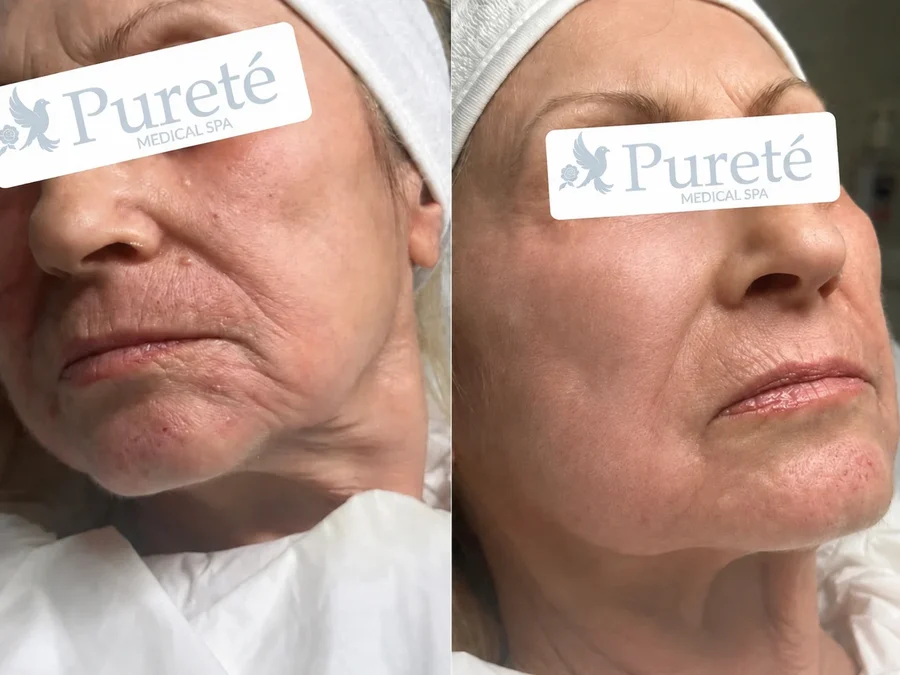 Potenza RF microneedling treatment room at Pureté Medical Spa in Etobicoke